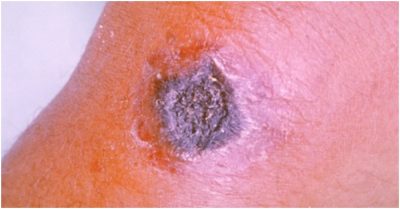 Bệnh than bùng phát ở Sơn Đông, Trung Quốc, có người chết, hàng trăm người bị cách ly ở nhiều làng