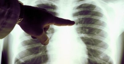 Ung thư phổi trở thành căn bệnh ung thư hàng đầu ở phụ nữ Trung Quốc, tỷ lệ mắc bệnh có xu hướng gia tăng